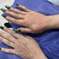 تزریق چربی جهت زیبائی دست و صورت