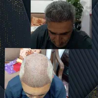 کاشت مو و ابروهاتو زیر نظر تیم و پزشک تهرانی