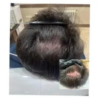 آموزش فیلر/بوتاکس/مزوتراپی|خدمات آموزشی|خرم‌آباد, |دیوار