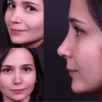 عمل جراحی زیبایی بینی،صورت،پلک،لیپو ابدو|خدمات زیبایی و سلامت|تهران, نازیآباد|دیوار