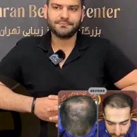 کاشت مو بصورت کاملاً تخصصی|خدمات آرایشگری و زیبایی|پاکدشت, پاکدشت (مامازند)|دیوار
