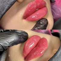 جراحی پلک غبغب صورت نخ آنزیم فیلر مزو ژل بوتاکس|خدمات آرایشگری و زیبایی|کرج, گوهردشت|دیوار