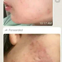 درمان اسکاروجای جوش|آرایشی، بهداشتی، درمانی|فیروزکوه, |دیوار