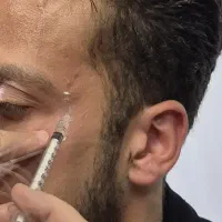 خدمات زیبایی ،بوتاکس، برداشتن خال، لیزر خال، مزوژل