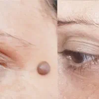 ریشه کن شدن زگیل تناسلی،میخچه، فقط بامحلول گیاهی