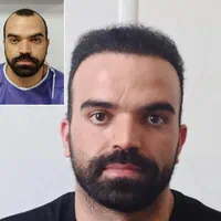 کاشت مو درکلینیک مجوزدار و پزشک متخصص با چک صیادی|خدمات آرایشگری و زیبایی|تهران, سعادت‌آباد|دیوار