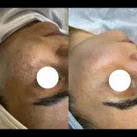 جوانسازی ،درمان پوست ،فیشال،پاکسازی،پوست کره ای|خدمات آرایشگری و زیبایی|شیراز, قدوسی غربی|دیوار