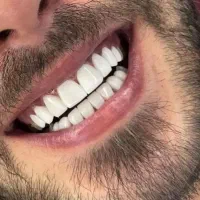 کامپوزیت از ۱م ایمپلنت دندان ۲۰م روکش.عصب کشی|خدمات زیبایی و سلامت|تهران, نارمک جنوبی|دیوار