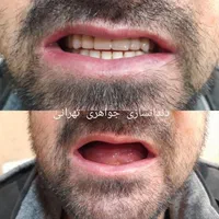 دندانسازی /دندان متحرک /دندان مصنوعی|خدمات آرایشگری و زیبایی|مشهد, حرم مطهر رضوی|دیوار