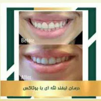بوتاکس فقط ۹۵۰ ( پیشانی لبخند لثه ای زیر بغل و..)|خدمات آرایشگری و زیبایی|محمدیه-قزوین, |دیوار