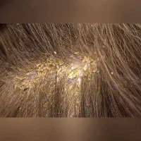 شامپو ضد شوره