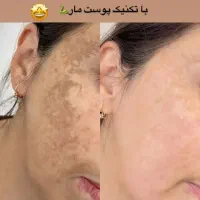 من اسکار،ولک پوستتو درمان میکنم بدون سوزن ودرد