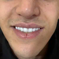 دندان مصنوعی + دندانسازی|خدمات آرایشگری و زیبایی|تهران, شمشیری|دیوار