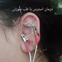 مرکز طب سوزنی نارمک|خدمات آرایشگری و زیبایی|تهران, وحیدیه|دیوار