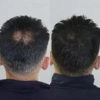 جلوگیری از پیشرفت ریزش مو