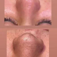 فیشال پوست .