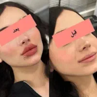لیفت جراحی بینی بلفارو ژل لب بوتاکس مزو فشیال
