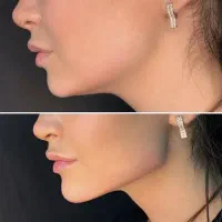 جشنواره تخفیف ۹۰درصدی تزریق ژل و بوتاکس صورت وبدن
