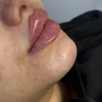 تزریق واموزش ژل و بوتاکس