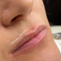 تزریق ژل لب و بوتاکس|خدمات آرایشگری و زیبایی|شیراز, شهرک مهدی‌آباد|دیوار