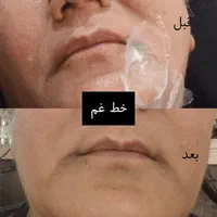 اف ۵۰٪ژل و بوتاکس و مزو...|خدمات آرایشگری و زیبایی|اهواز, اهواز|دیوار