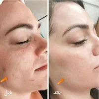 آموزش وخدمات فیشال،پی آرپی،مزوتراپی، مزونیدیلینگ|خدمات آرایشگری و زیبایی|کرج, گوهردشت|دیوار