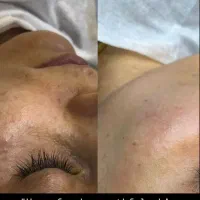 پاکسازی و فیشال/ آقایان و بانوان|خدمات آرایشگری و زیبایی|هشتگرد, هشتگرد قدیم|دیوار