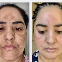 به مدل جهت انجام تکنیک آیینه سازی پوست|خدمات آرایشگری و زیبایی|ورامین, ورامین|دیوار