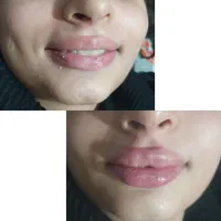 آفرویژه ژل،بوتاکس،اموزش (به مدت محدود )