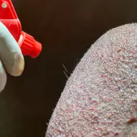 کاشت موی تخصصی