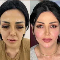 کلینیک تخصصی پوست هایفو ژل نخ آموزش حرفه ای ژل نخ|خدمات آرایشگری و زیبایی|تهران, زعفرانیه|دیوار