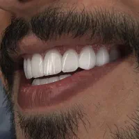 دندانسازی دندان مصنوعی (توضیحات)