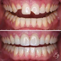 خدمات کامپوزیت دندان و زیبایی دندان|خدمات آرایشگری و زیبایی|زنجان, |دیوار