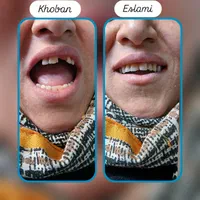 خدمات تخصصی پروتز متحرک(دندان مصنوعی)|خدمات آرایشگری و زیبایی|قزوین, |دیوار