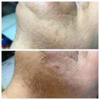 الکترولیز(رفع دائمی موهای سفید،بور،هورمونی)