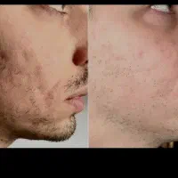 درمان همیشگی تورفتگی پوست/ جای جوش/اسکار/اگزوزوم