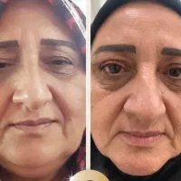 عمل افتادگی پلک ( بلفاروپلاستی ) با تعرفه دولتی|خدمات زیبایی و سلامت|تهران, سلسبیل جنوبی|دیوار
