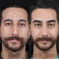 میکروبلیدینگ ابرو برای آقایان