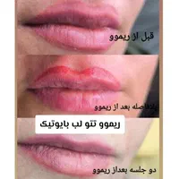 ریموو تتو با اشانتیون  در کلینیک زیبایی|خدمات آرایشگری و زیبایی|تهران, تهرانپارس غربی|دیوار