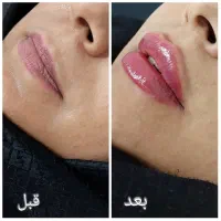 تزریقات زیبایی با تکنیک روز و نتیجه طبیعی