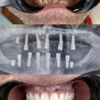 ایمپلنت دیجیتال کرمان اقساط ویژه گارانتی معتبر