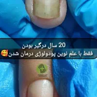 درمان ناخن فرورفته درگوشت بدون جراحی در کلینیک|خدمات آرایشگری و زیبایی|ورامین, خیر آباد|دیوار