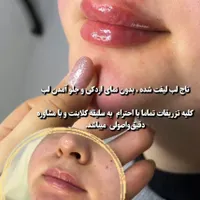 لیزر موهای زاید تزریق بوتاکس وژل توسط پزشک
