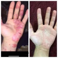 پیسی و پسوریازیس|خدمات آرایشگری و زیبایی|کرمانشاه, |دیوار