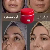 کرم سوپر معجزه صدرصد اصلی و ضمانتی|آرایشی، بهداشتی، درمانی|سنندج, |دیوار