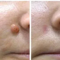 خالبرداری تخصصی فیلربوتاکس پی ارپی مزوتراپی