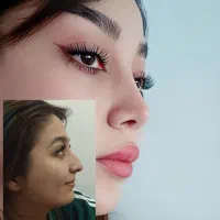 عمل بینی جراح گوش حلق بینی،اقساطی، از دم قسط