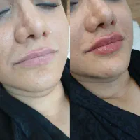 تزریق ژل فیلر بوتاکس مزوتراپی مزوژل لیزر فیشیال|خدمات آرایشگری و زیبایی|کرج, گوهردشت|دیوار