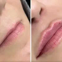 تزریق لب، خط خنده، گونه و کانتورینگ صورت