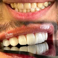 خدمات تخصصی کامپوزیت ونیر با کیفیت و شرایط اقساط